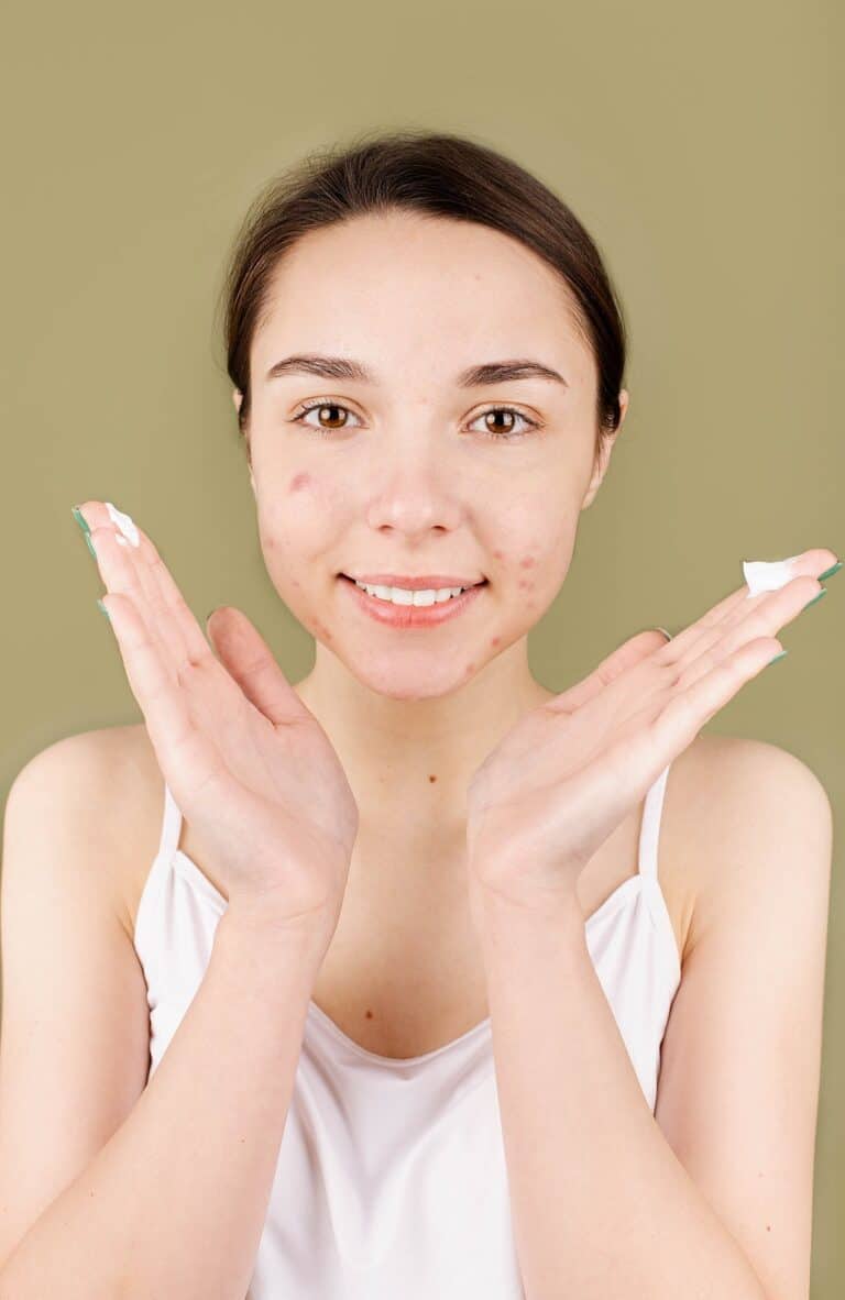 Acne Scars