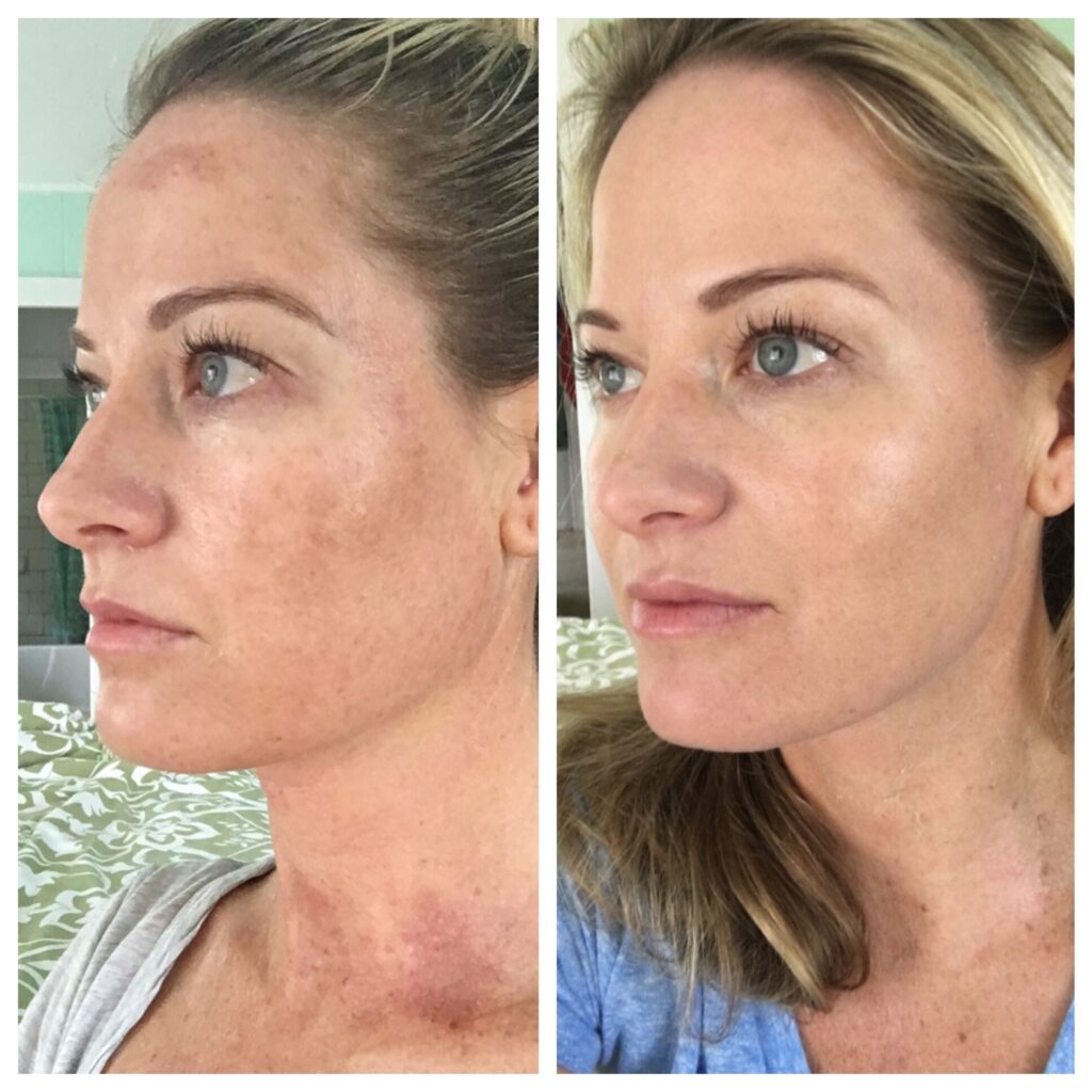 Chemical Peels before and after1