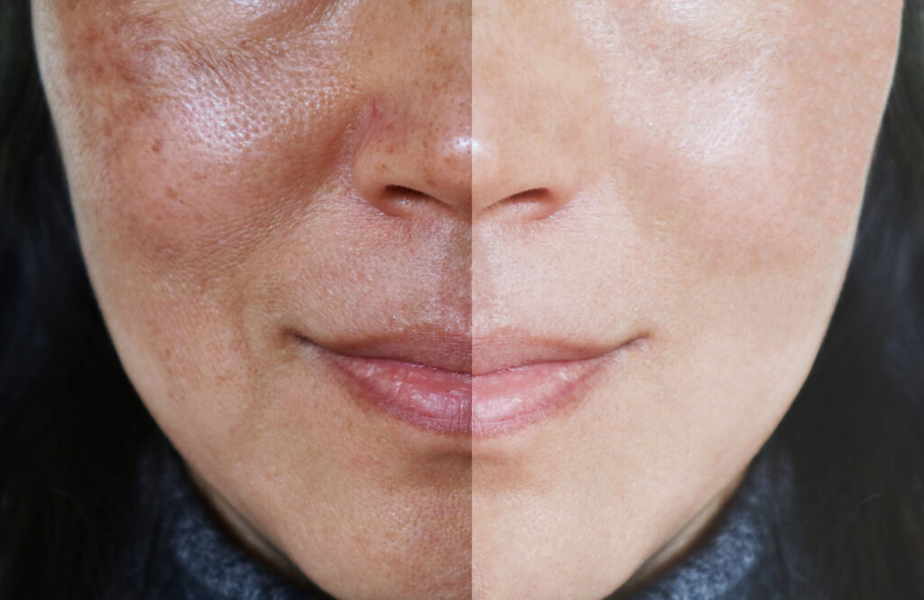 Hydrafacial-Benefits