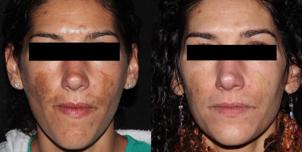PicoSure-Laser-Treatment-BAs