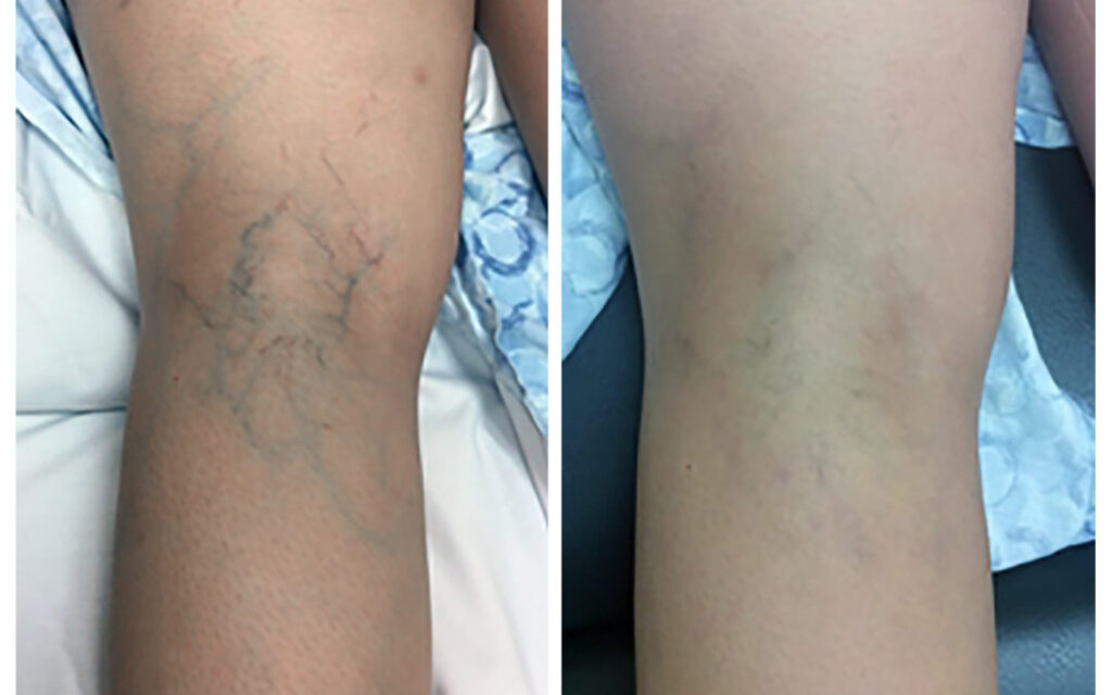 Totality-Before-After-Sclerotherapy-4-1080x675