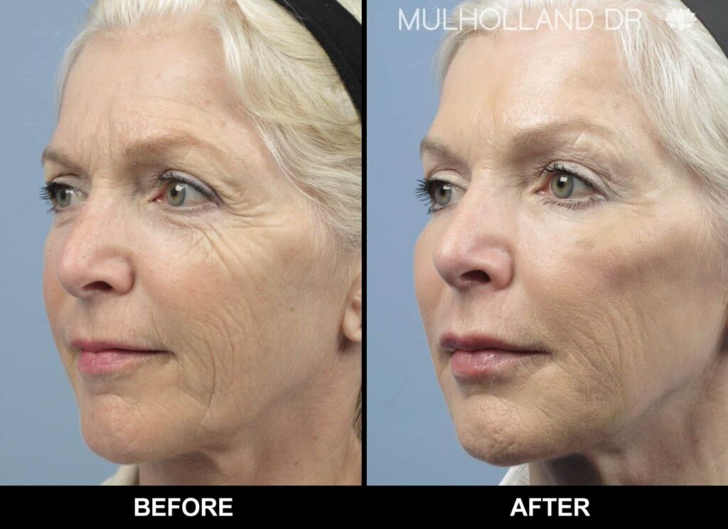 co2-laser-resurfacing 2