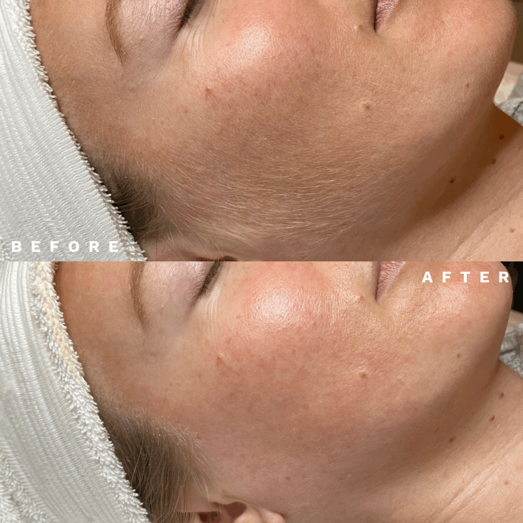 dermplaning before after