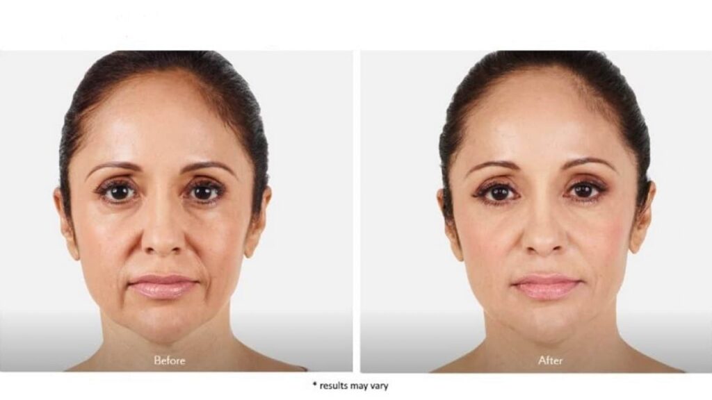 juvederm-before-and-after-westchester-park-avenue-medical-spa-1280x720-1