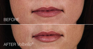 juvederm-volbella-for-lips-before-and-after