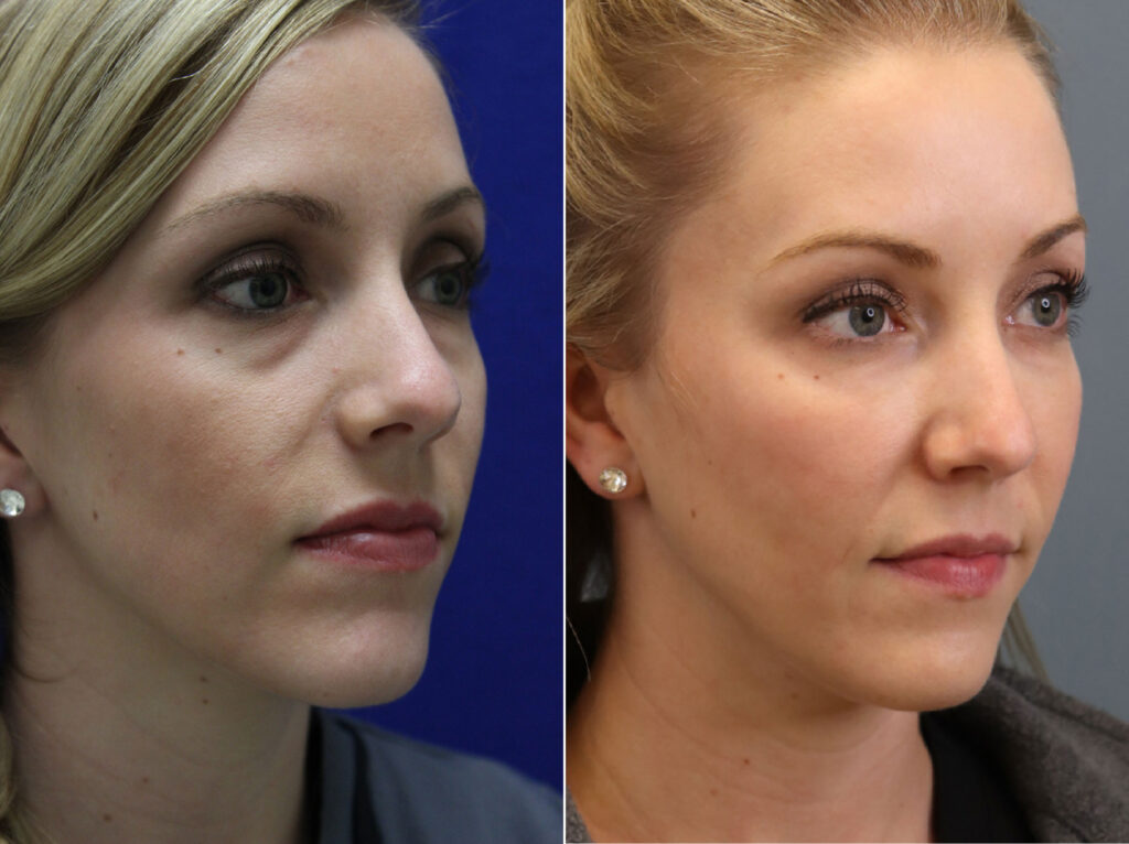 juvederm-voluma-xc before and after1