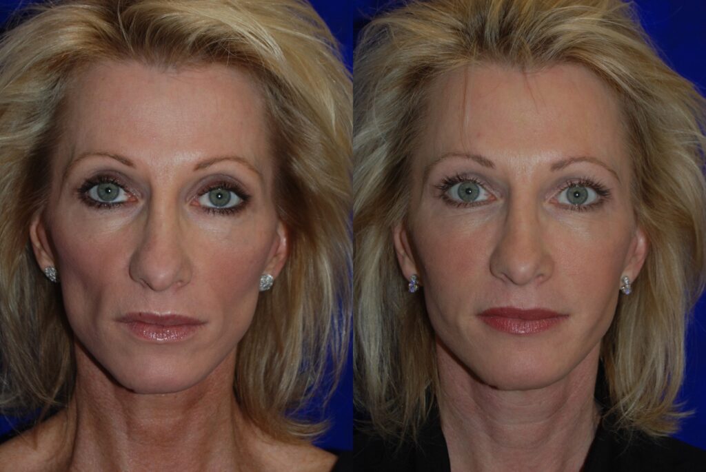 juvederm-voluma-xc before and after2