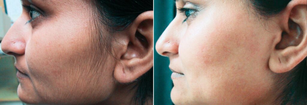 laser-hair-removal-before-after-1