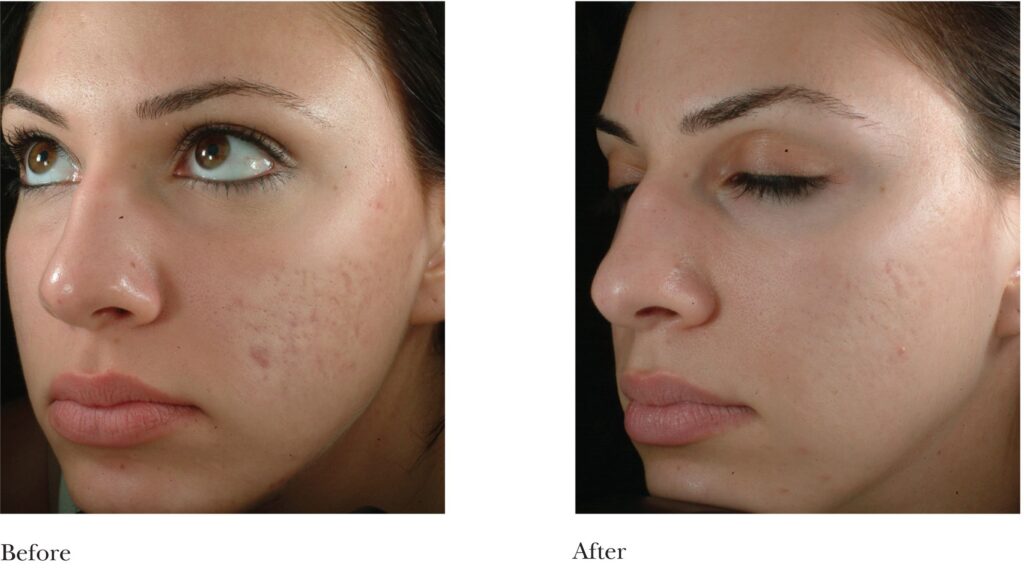 microderm new