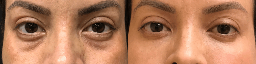 thermismooth-skin-tightening 1