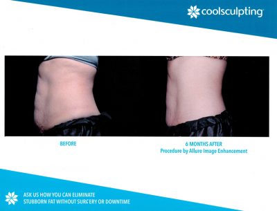 62424e25e005760bd175e02f_AllureImage_Coolsculpting_Before_After