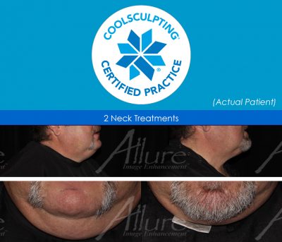 CoolSculpting®